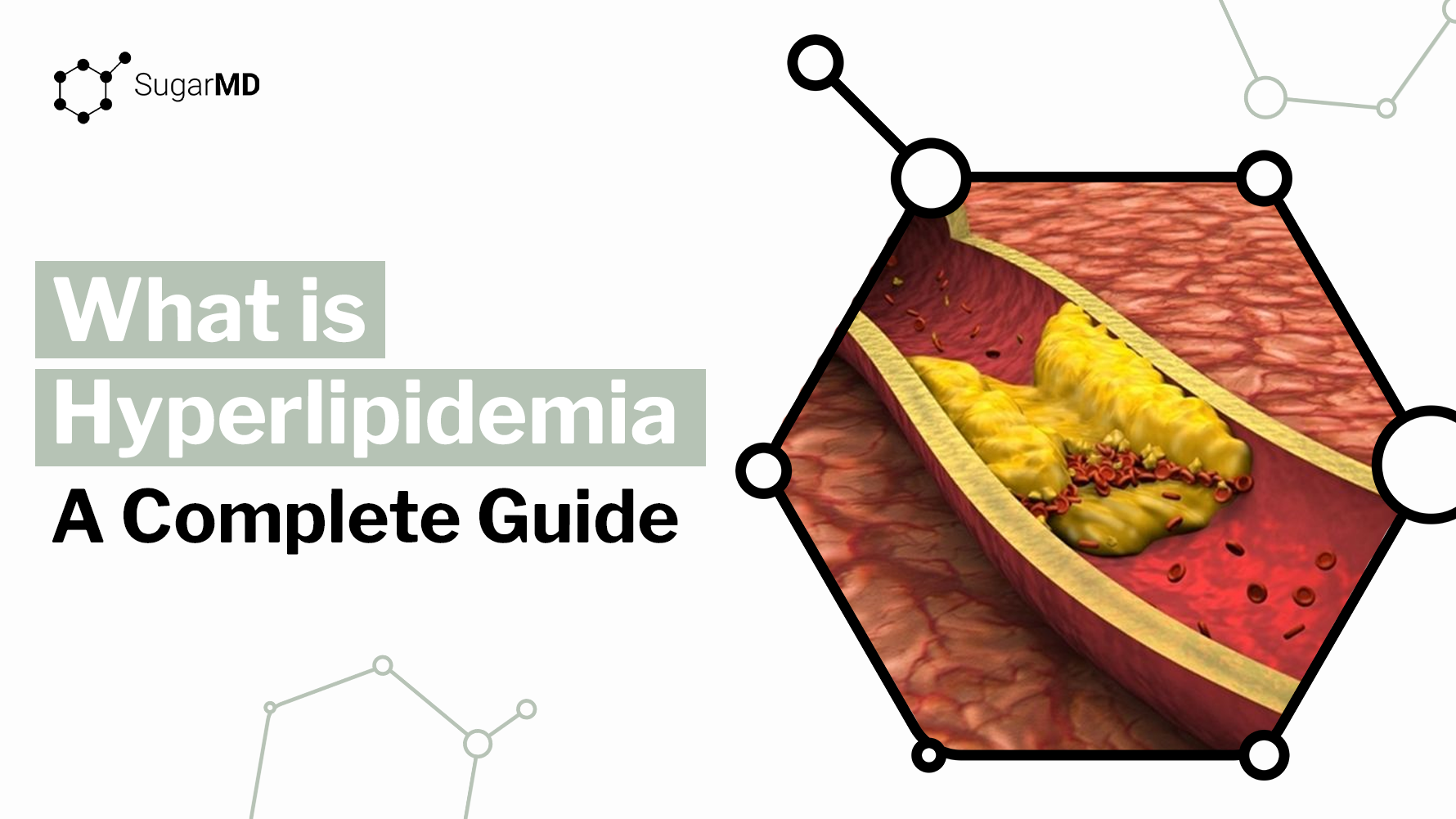 Hyperlipidemia illustration showing plaque buildup inside an artery with narrowed blood flow